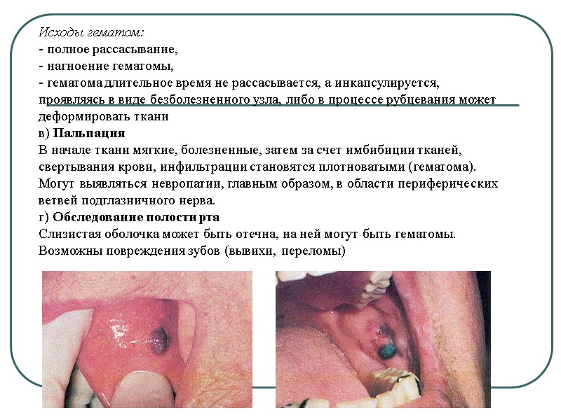 Исходы гематом: - полное рассасывание, - нагноение гематомы, - гематома длительное время не рассасывается,